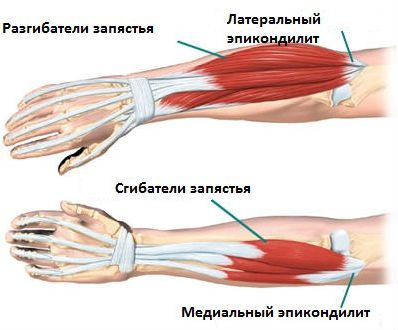 Эпикондилит