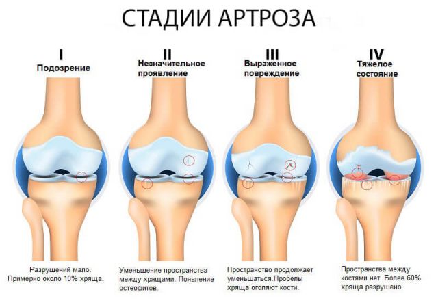 Стадии артроза