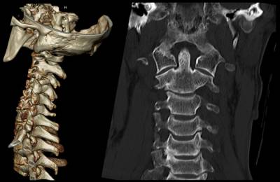 КТ шейного отдела позвоночника