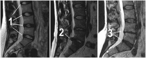 МРТ пояснично-крестцового отдела