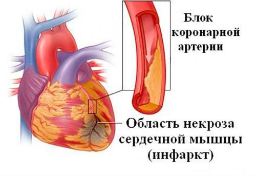 Инфаркт миокарда