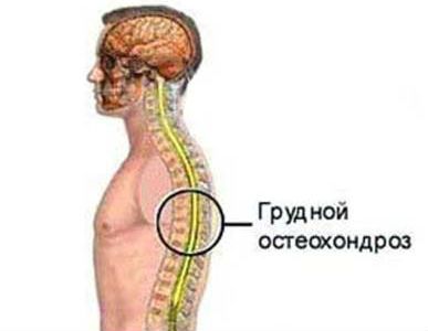 Грудной остеохондроз