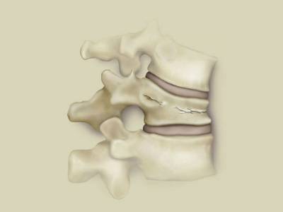 Компрессионный перелом позвоночника
