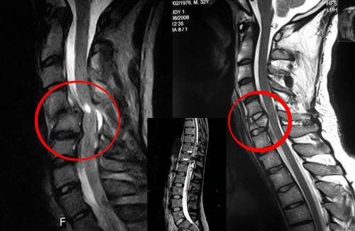 МРТ шейного перелома позвоночника