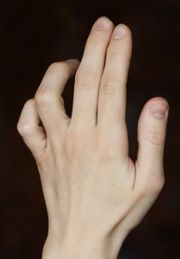 Деформация положения пальцев