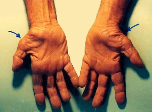 Атрофия мышц на руке