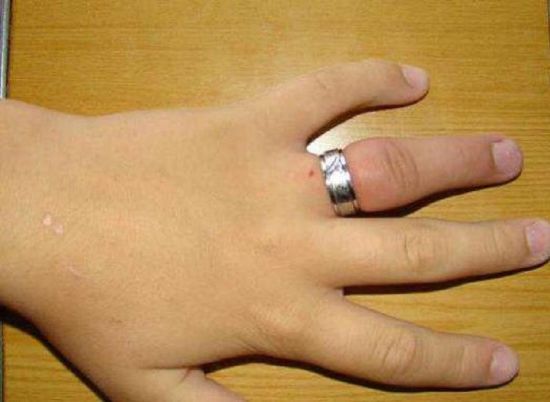 Отекшая рука и кольцо на пальце