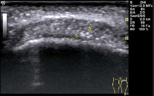 УЗИ коленного сустава