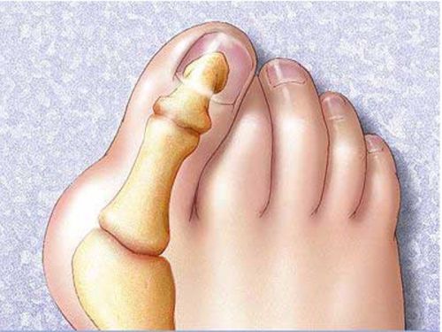 Деформированный палец ноги