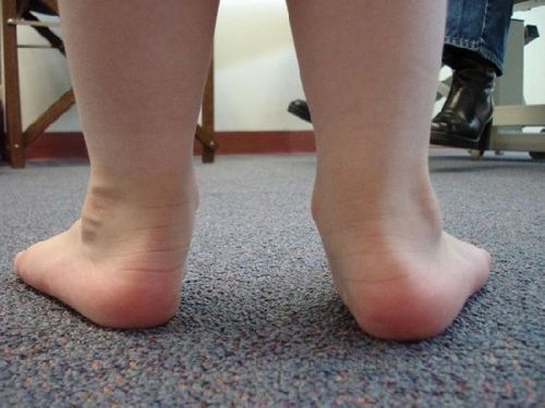 Кривые детские ножки