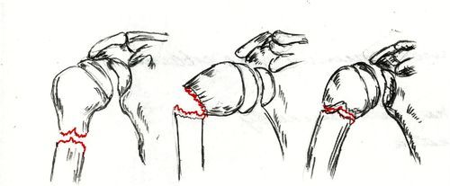 Перелом плечевой кости