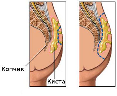 Киста возле копчика