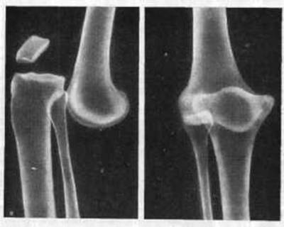 Вывих голени на рентгенограмме