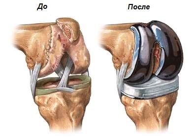 коленный сустав до и после эндопротезирования