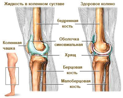 Синовит коленного сустава