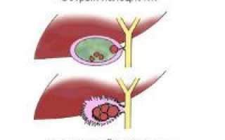 Что такое холецистит