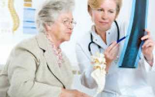 Как лечить остеопороз костей