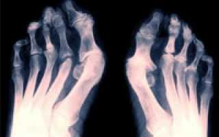 Особенности артрита суставов стопы и его лечение