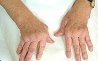 Полиартрит пальцев рук и его лечение