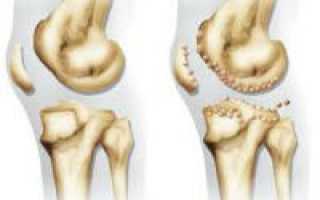Особенности деформирующего остеоартроза суставов и его степени