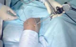Артроскопия коленного сустава как метод лечения и диагностики
