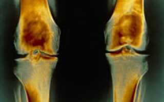 Посттравматический остеоартроз и его лечение