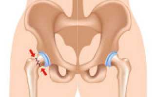 Перелом шейки бедренной кости