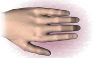 Как лечить артроз пальцев: что рекомендуют врачи?