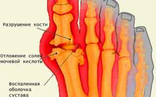 Подагра – что это за болезнь?