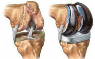 Хирургическое лечение заболеваний коленного сустава