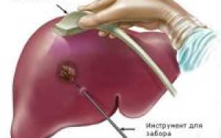 Биопсия (пункция) печени