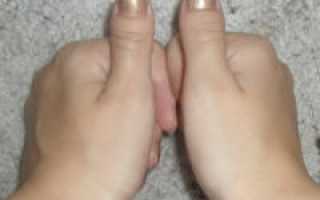 Брахидактилия большого пальца