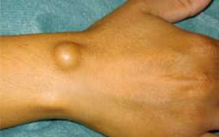 Гигрома лучезапястного сустава и способы ее лечения