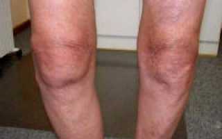 Как лечить остеоартроз коленного сустава