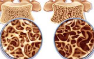 Особенности остеопороза 1 степени