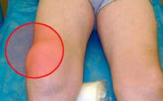 Отек коленного сустава: причины и лечение