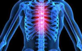 Симптомы и лечение грудного радикулита