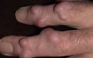 Особенности гигромы на пальце руки