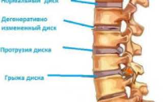 Лечение протрузии дисков поясничного отдела позвоночника