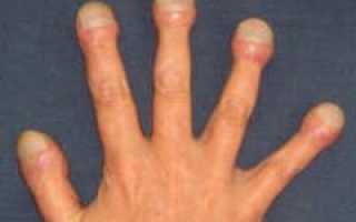 Синдром пальцев Гиппократа