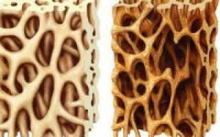 Особенности остеопороза 4 степени