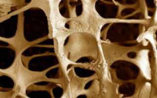 Остеопороз – что это за болезнь?