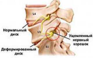 Остеохондроз позвоночника с корешковым синдромом