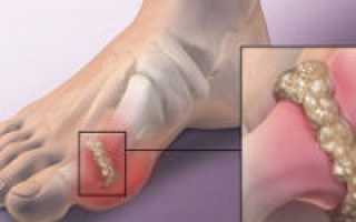 Лечение подагры большого пальца ноги