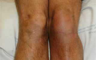 Бурсит коленного сустава и его лечение