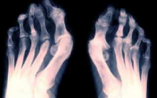 Чем и как лечить артрит суставов стопы