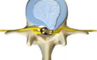 Протрузия дисков поясничного отдела позвоночника