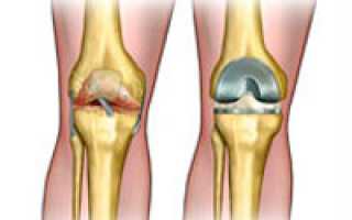 Эндопротезирование коленных суставов и реабилитация после него