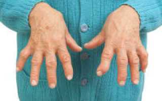 Ревматоидный артрит пальцев на руках