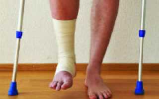 Перелом ноги в лодыжке